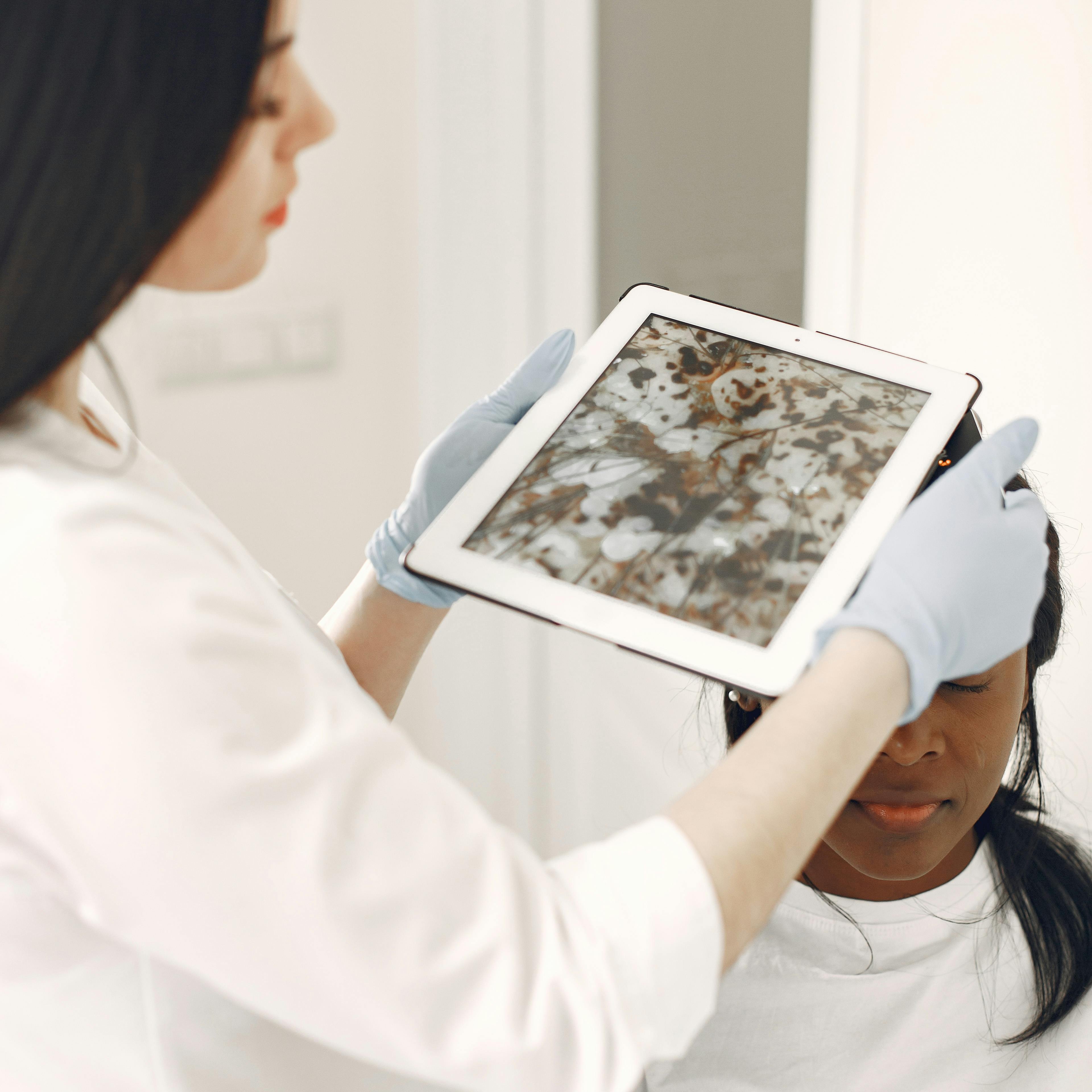 Microneedling with PRP